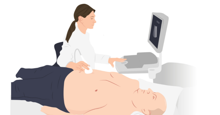 Ultrasound for abdominal aortic aneurysm